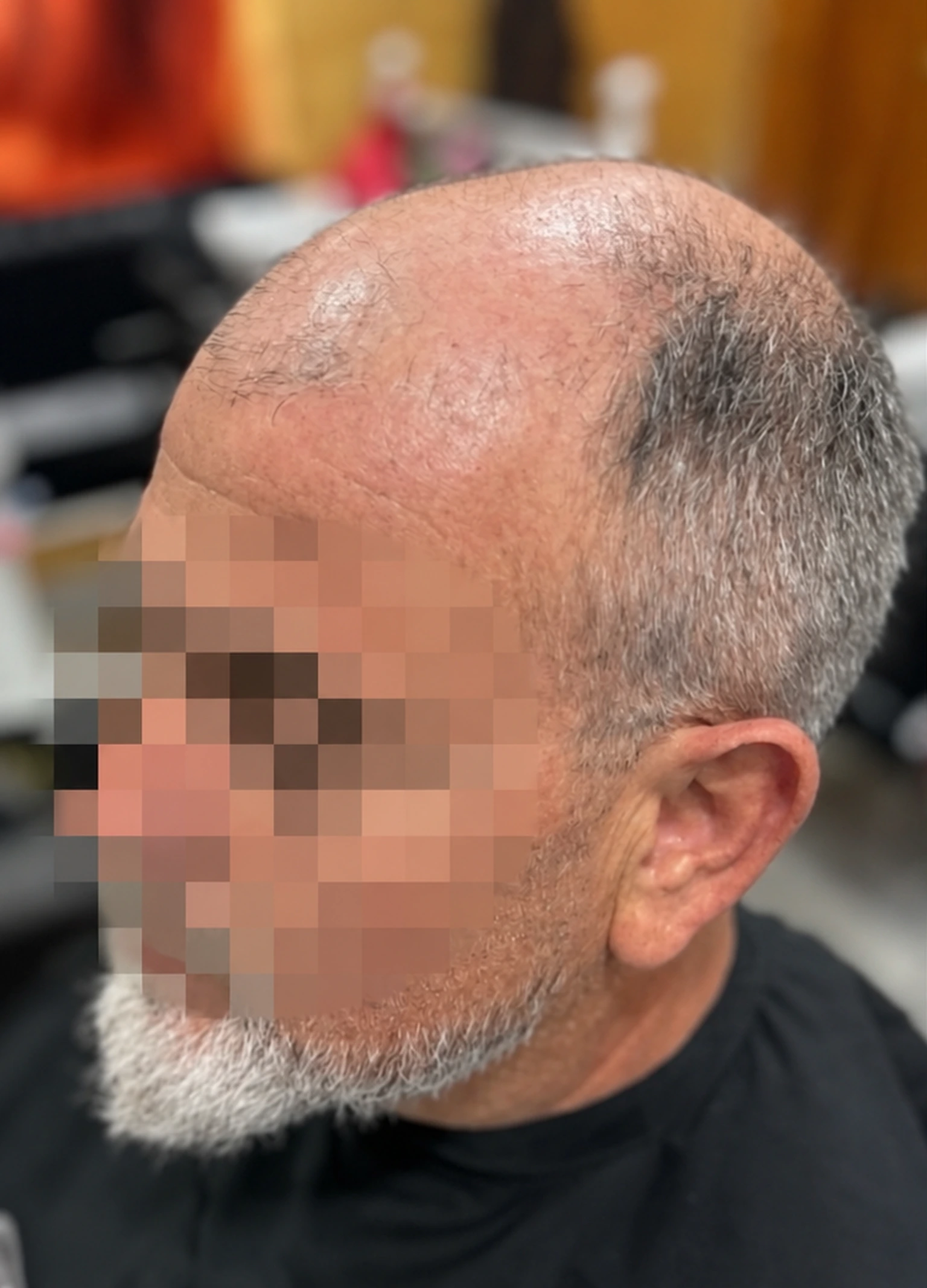 Antes de colocar la prótesis capilar, con el rostro pixelado