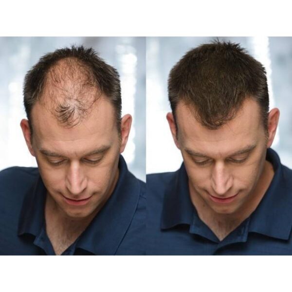 Comparativa antes y después de un hombre con prótesis capilar natural